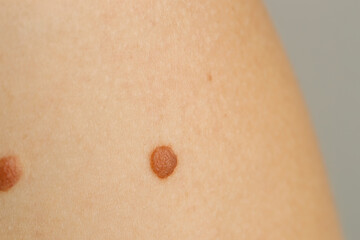 Fototapeta premium Woman with moles on her skin against light grey background, closeup