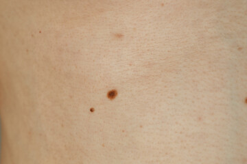 Fototapeta premium Man with birthmarks on his skin, closeup