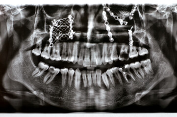 Panoramic X Ray shows multiple plates, screws for maxillary fixation of a fractured maxilla,...