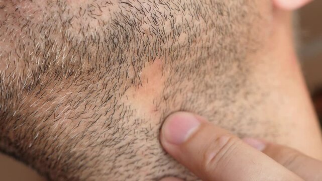 Alopecia on the beard of a man. Baldness on the hairline.