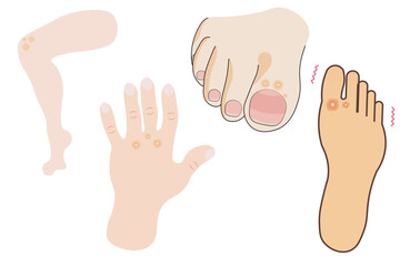 Warts and verrucas are skin growths caused by the human papillomavirus (HPV). Related conditions include plantar warts, genital warts, and common warts. HPV can also lead to cervical,other cancers