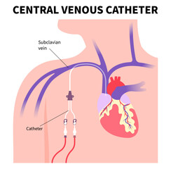 Vascular access surgery for kidney disease with intravenous injection tube inserted on arm blood vessel in medical care