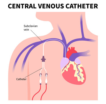 Vascular access surgery for kidney disease with intravenous injection tube inserted on arm blood vessel in medical care