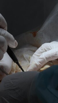 Cardiac surgeon and team perform median sternotomy. Action. Surgeon cauterizing and using professional tool.