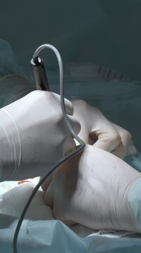 Close up of hands of surgeons team during operation with surgical laparoscopy instruments. Action. Team of surgeons at work in a hospital.