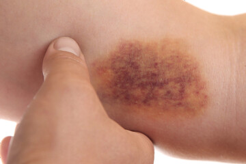 Woman with bruise on arm against white background, closeup