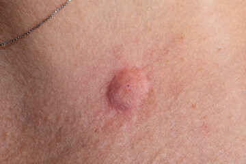 Fototapeta premium Close-up of a large keloid scar on woman's chest