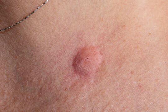 Close-up of a large keloid scar on woman's chest