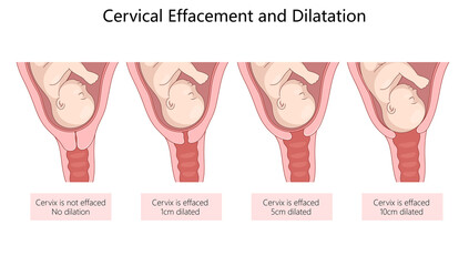 stages of cervical effacement and dilation during labor, depicting gradual opening and thinning of the cervix diagram hand drawn schematic raster illustration. Medical science educational illustration