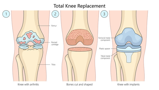 total knee replacement surgery, progression from arthritis-damaged knee to bone shaping and implant placement diagram hand drawn schematic raster illustration. Medical science educational illustration