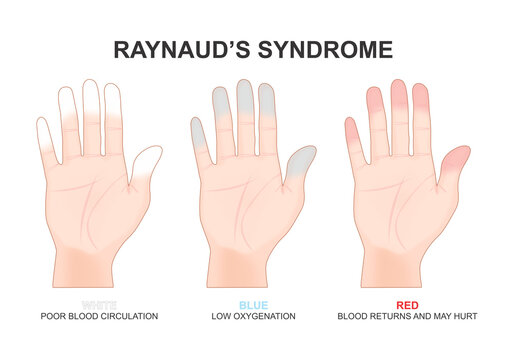 Raynaud's syndrome decreased blood flow to the fingers illustration