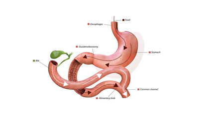 Digestive process after surgery: stomach, food pathway, duodenoileostomy, bile flow, alimentary limb, common channel, and ascending colon, 3d graphic