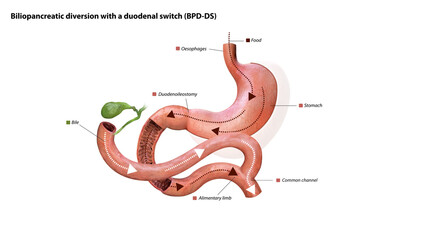 Digestive process after surgery: stomach, food pathway, duodenoileostomy, bile flow, alimentary limb, common channel, and ascending colon, 3d graphic