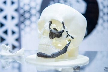 Prototype of human skull from white plastic with titanium implants in form of plates and surgical templates printed on 3D printer. Biointegrated prosthesis. Medicine medical