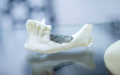 Prototype of lower human jaw with medical titanium implant from biocompatible titanium printed on 3D printer. Maxillo-facial prosthesis anatomical human bone from metal powder. Medicine medical