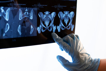 Doctor hand showing Computed tomography image of SI (Sacroiliac) joint showing sacroiliitis of...