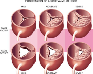 Medical illustration showing the progression of aortic valve stenosis, both open and closed with annotations.