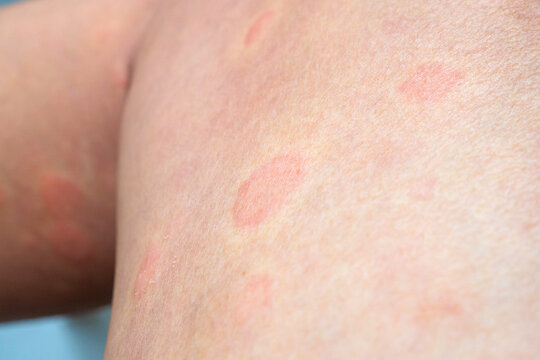 Young asian man has allergic skin rash on his legs from itchy dry skin eczema dermatitis insect bites