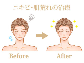 美容皮膚科でニキビ治療した大人男性のビフォーアフターのイラスト素材