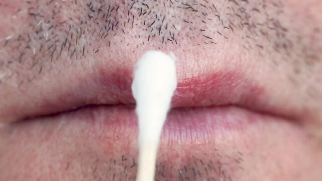A man applies herpes ointment to his lip with a cotton swab