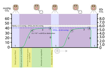 Capnography Waveform Detailed Infographic