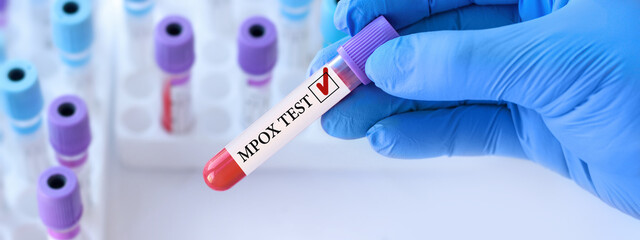 Obraz premium Doctor holding a test blood sample tube with Monkeypox virus (MPXV) .The virus is transmitted from animals to humans. Infected people suffer from fever, cough, headache, nausea and vomiting