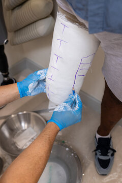 Creating custom prosthetic leg, technician marking plaster mold for patient