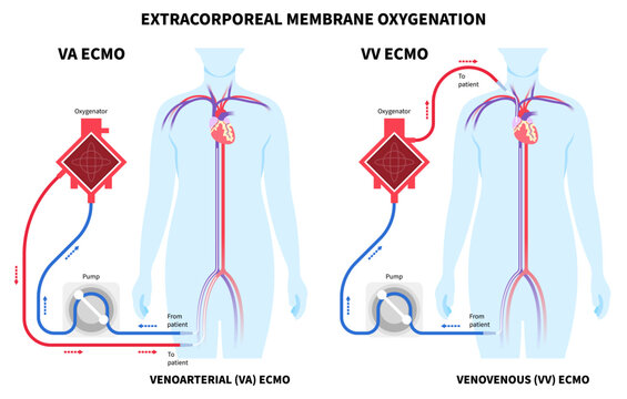 Life support system with the Extracorporeal Membrane Oxygenation or ECMO for Respiratory failure and illness patient
