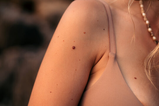 Moles in the skin of a woman