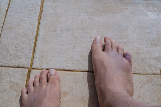 Fractured little pinky toe finger in a right foot bruised