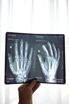 Hand Holding X-ray Image of Human Hands