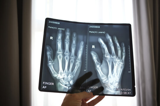 Hand Holding X-ray Image of Human Hands