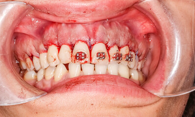Gummy smile correction surgical clinical case. Third surgery step: gum suturing after bone defect correction and gingival repositioning with the right alignment in upper position. © MSC