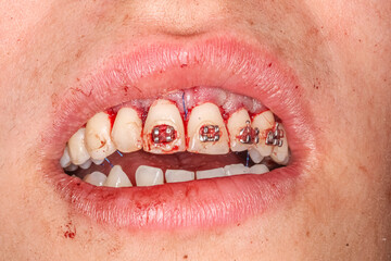 Gummy smile correction surgical clinical case. Third surgery step: gum suturing after bone defect correction and gingival repositioning with the right alignment in upper position. © MSC