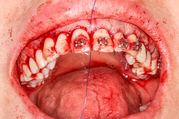 Obraz premium Gummy smile correction surgical clinical case. Third surgery step: gum suturing after bone defect correction and gingival repositioning with the right alignment in upper position.
