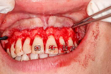 Gummy smile clinical case with orthodontic brackets. Second surgery step: gingival retraction with dental strippers instruments. Surgical detachment, exposing the alveolar bone and contour reshaping.  © MSC