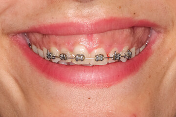 Gummy smile clinical case with orthodontic brackets and metallic wire. Patient shows an uneven gum line on frontal maxillary central incisors before gum contouring reshaping surgery.