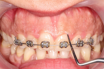 Gummy smile clinical case with orthodontic brackets and metallic wire. Cheeks and lips retracted with a cheek retractor, probing gums with a periodontal probe before contouring surgery © MSC