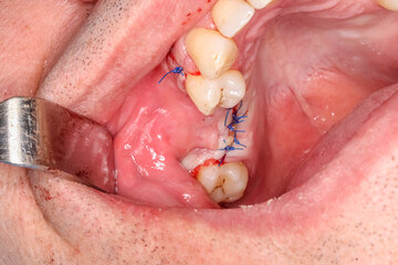 Dental surgery case showing a maxilla with an extracted tooth and alveolar bone defect filled with bone and gingival grafts, sutured with blue thread. Metallic cheek retractor in place.