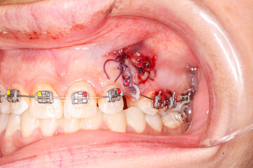 Dental surgery case showing a maxilla with an extracted tooth and alveolar bone defect filled with bone and gingival grafts, sutured with blue thread. Transparent pastic cheek retractor in place. © MSC