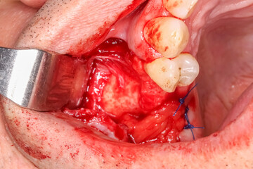 Dental surgery case showing a maxilla with an extracted tooth and alveolar bone defect filled with bone and gingival grafts, sutured with blue thread. Metallic cheek retractor in place.