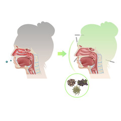 알레르기비염 한약 침 한의학 치료 효과