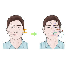 안면신경마비 구안와사 한의학 치료 효과