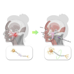 안면신경마비 구안와사 한의학 치료 효과