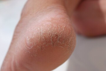 Cracked heel. Skin problems caused by dryness and poor circulation