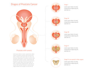 0711_cancerDetailed illustration depicting the different stages of prostate cancer, from early to advanced stages. The image includes a representation of the prostate with tumors in var_prostata_eltos