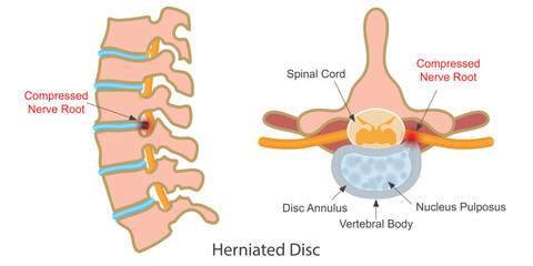 Herniated disk is a condition that can occur anywhere.