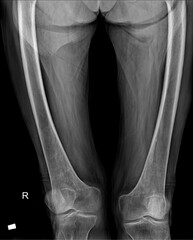 Femur X-Ray: Comprehensive Diagnostic Evaluation of Bone Structure