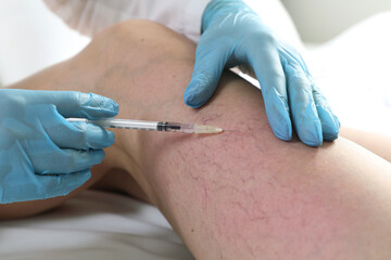 Varicose veins treatment. Doctor giving injection to patient indoors, closeup