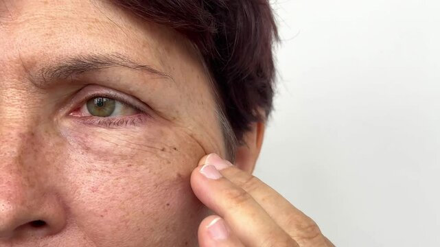 Elderly caucasian woman with pigmented spots, puffiness and facial wrinkles under her eyes touching her face on a white background. Age-related skin changes, fatigue. Cosmetology and beauty concept